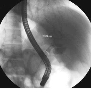 Endoscopic retrograde cholangiopancreatography (ERCP) digital image of ...