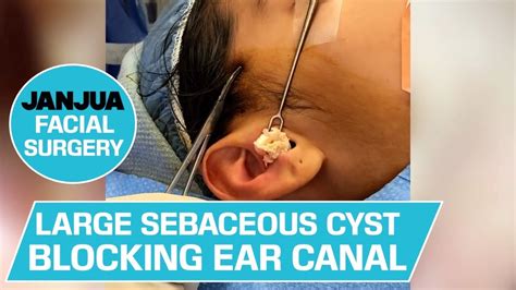 LARGE SEBACEOUS CYST BLOCKING EAR CANAL IN TEENAGER - DR. TANVEER JANJUA - NEW JERSEY - YouTube