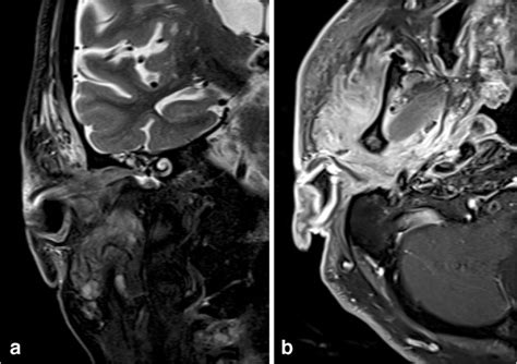 Necrotizing otitis externa. Coronal T2-weighted image (a) demonstrates ...