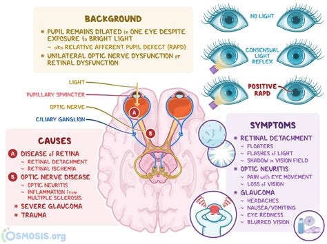 Marcus Gunn Pupil: What Is It, Causes, Treatment, and More | Osmosis