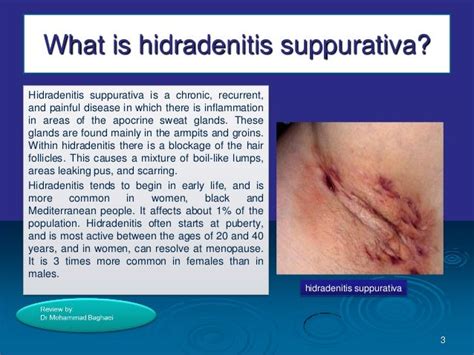 Hidradenitis Suppurativa Stage 3