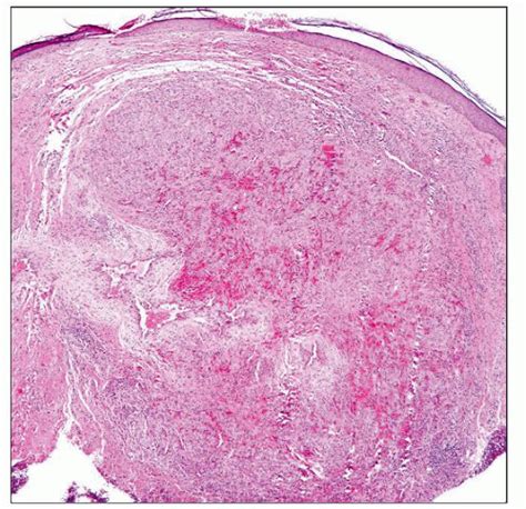 Angiolymphoid Hyperplasia with Eosinophilia | Basicmedical Key