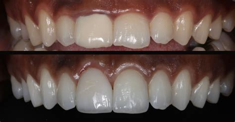 How does a gum lift treatment work? | Enamel Dentistry