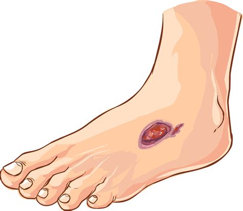 Causes Foot Ulcer Wound | Werkman, Boven & Associates