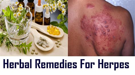 Herbal Remedies For Herpes | Top Natural Herbal Remedies For Treatment ...