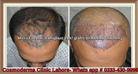 Hair Transplant in Sialkot | Hair loss treatment clinic | Best hair surgeon