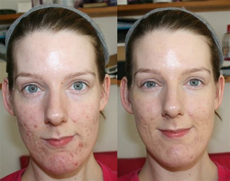 BareMinerals BareSkin Foundation Before and After - Beauty Geek UK