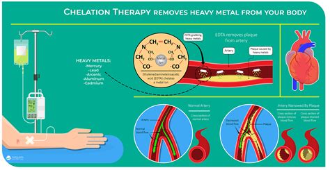 IV Chelation Therapy - Heavy Metal Treatment - Dr. Lalezar