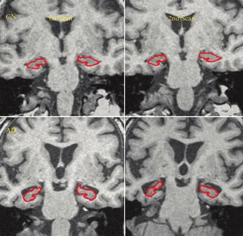 Hippocampal atrophy detected in AD patients. Two MRI scans 1 year apart... | Download Scientific ...