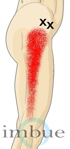 Thigh Pain: Where is it Coming From & What to Do? - Dr. Peter Borten, LAc, DAOM