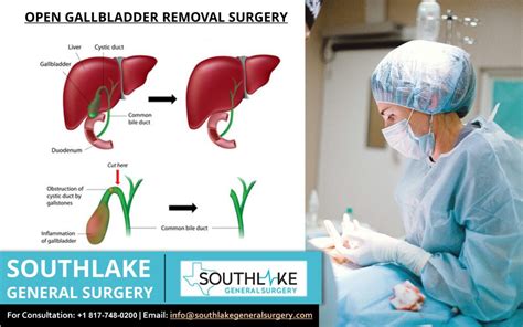 Open Gallbladder Removal Surgical Procedure - Southlake General Surgery
