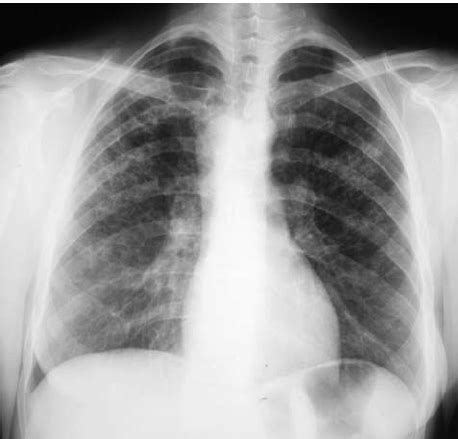 Chest X-ray of a 46 year-old patient, smoker, with pulmonary... | Download Scientific Diagram