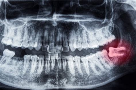 Normal Wisdom Teeth Growth