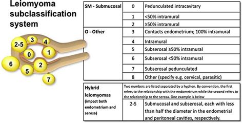 Myomas - Pictures