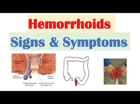 Hemorrhoids - Causes, Types, Stages, Symptoms, Treatment | Diseases 2024