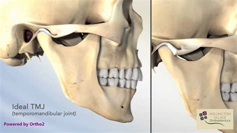 Closed Lock TMJ (Lock Jaw) - Wellington Village Orthodontics - YouTube