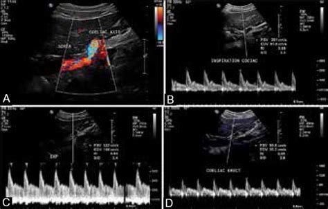 Celiac artery compression Ultrasound - increased velocities | Celiac artery, Arteries, Ultrasound