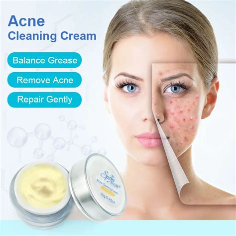 Spoya Hot Selling 15g Acne Cleaning Cream Remove Repair Pimple Acne Quickly Balance grease Acne ...