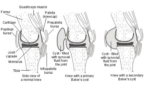 Baker Cyst or Popliteal Cyst | Bone and Spine