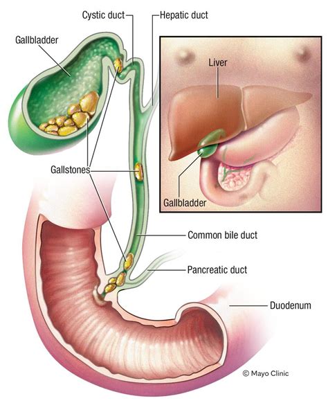 Gallbladder Pain In Back