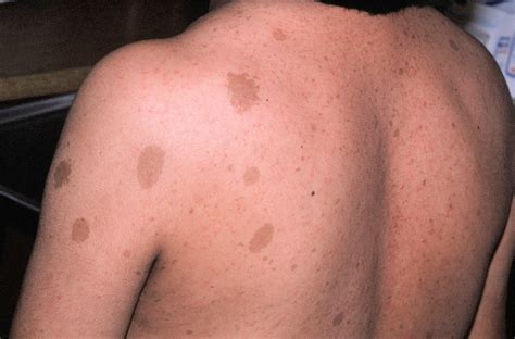 Neurofibromatosis - Causes, Types, Symptoms, Diagnosis, Treatment