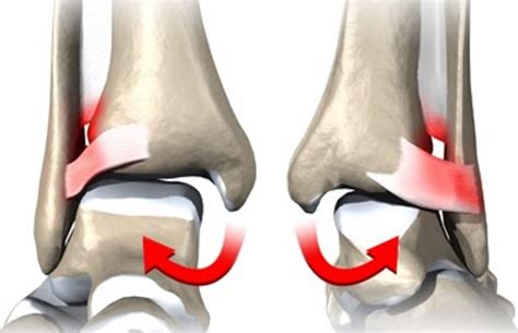 Syndesmosis Injury (High Ankle Sprains) | Watsonia Podiatry