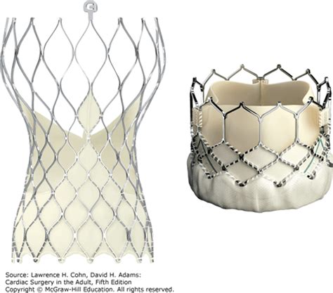 Stented Bioprosthetic Aortic Valve Replacement | Thoracic Key