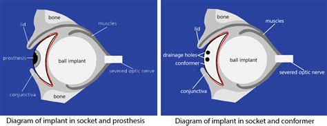 Enucleation and Evisceration | Kellogg Eye Center | Michigan Medicine