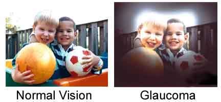 Eye Diseases - Glaucoma