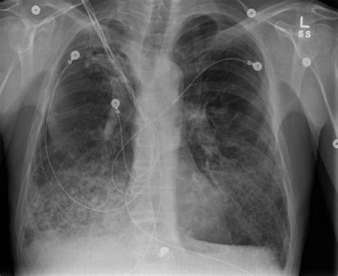 Blastomycosis Lung X Ray