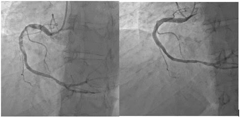 Particularity of Coronary Artery Aneurysm Management | Auctores