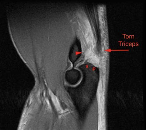 Triceps Tendon Tears – Dr. Edward Weldon