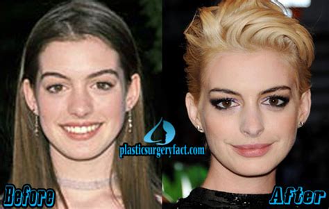 Anne Hathaway Plastic Surgery Before After