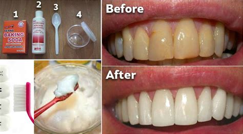 How To Remove Plaque From teeth Without Expensive Treatments It's easy - 3inaa