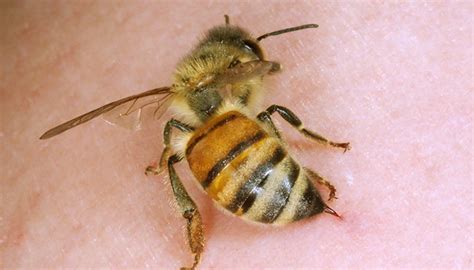 How to Treat Bee Stings - What to Do for Bee Stings