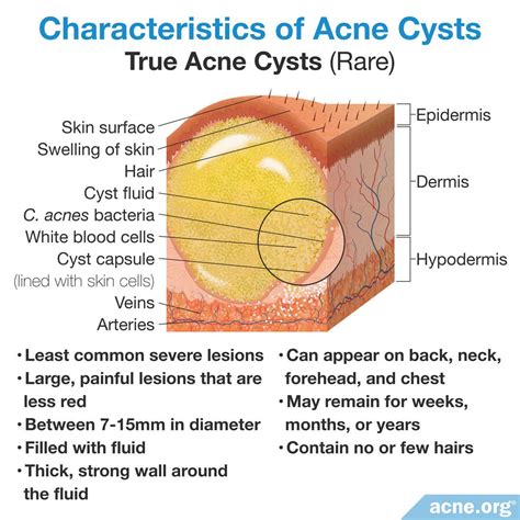 What Is an Acne Cyst? - Acne.org