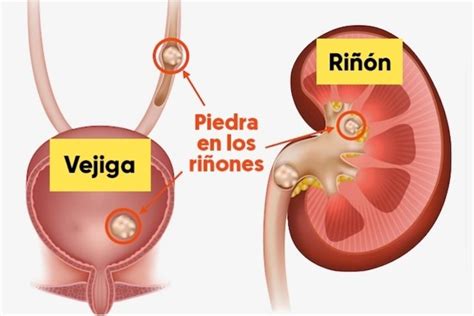 Piedras en los riñones: principales síntomas, causas y cómo eliminarlas (con test online) - Tua ...