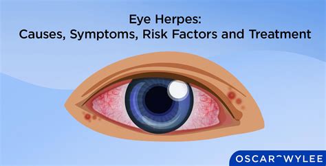 Eye Herpes: Causes, Symptoms, Risk Factor and Treatment