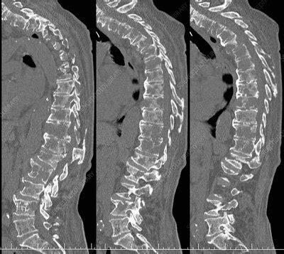 Secondary spinal cancer, CT scans - Stock Image - C021/2288 - Science Photo Library