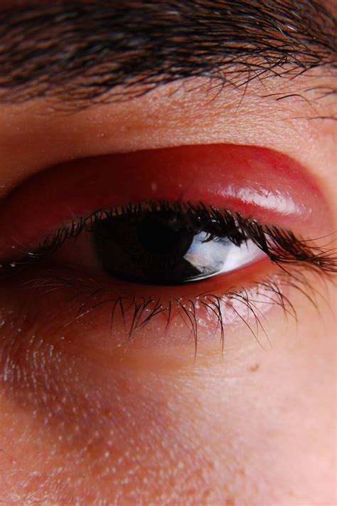 Shingles in the eye: Symptoms, treatment, and prevention