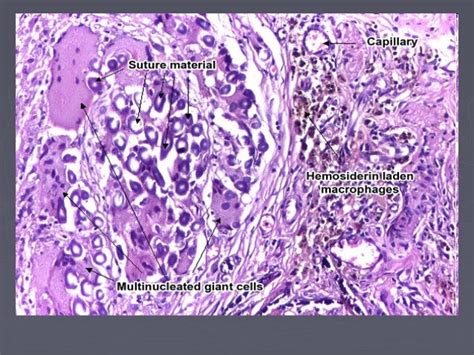 Chronic granulomatous inflammation