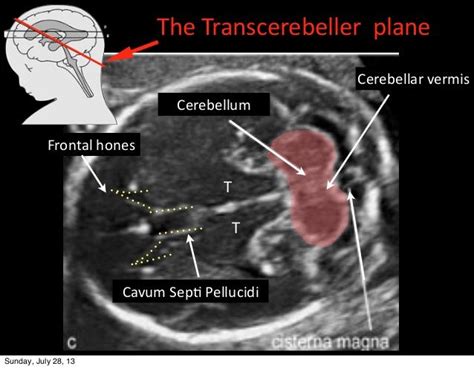 cerebellar and cisterna magna on ultrasound - Google Search | Medical ultrasound, Ultrasound ...