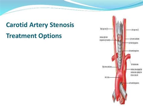 Carotid Artery Stenosis Treatment Options