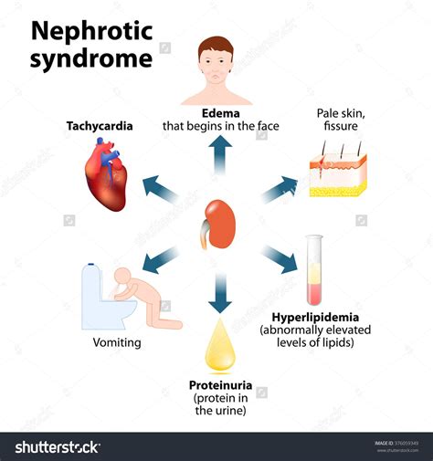 Pin by Shey D. on enfermeria | Nephrotic syndrome, Edema, Nurse