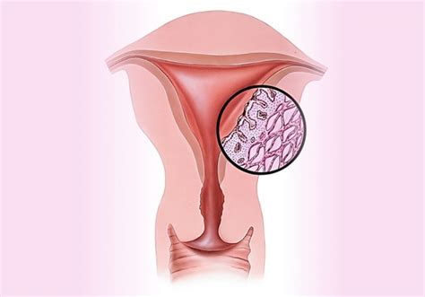 Dysmenorrhea | London Obs and Gynae Clinic | Gynaecology