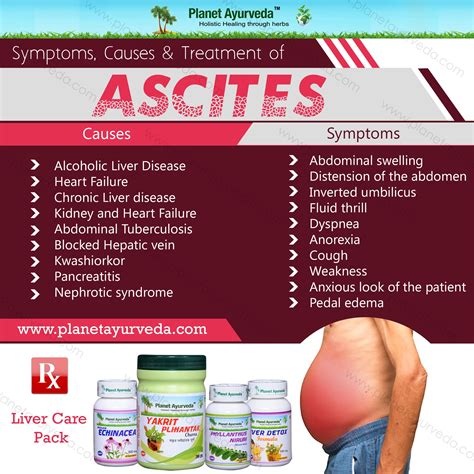 Ascites causes symptoms and herbal treatment – Artofit