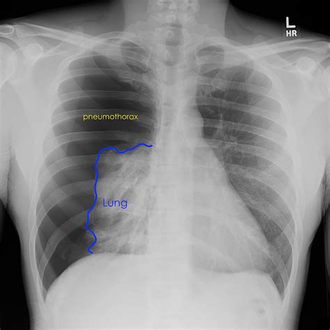 Massive Spontaneous Pneumothorax | Cureus