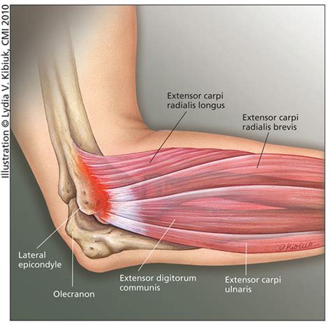 Tennis Elbow; Epicondylitis, Lateral Humeral