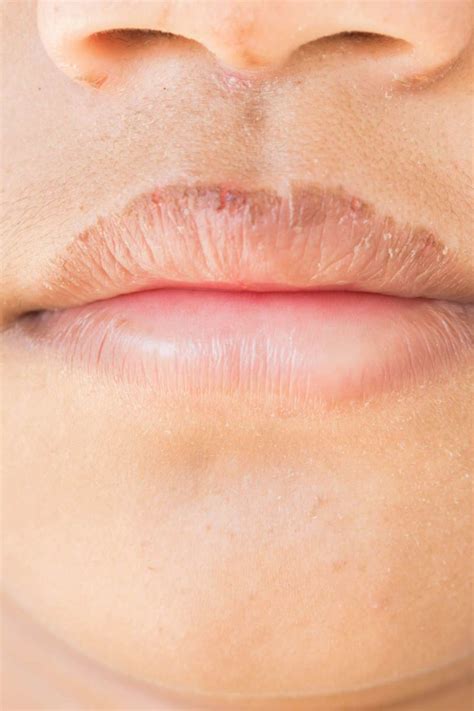 How to get rid of chapped lips: 6 ways