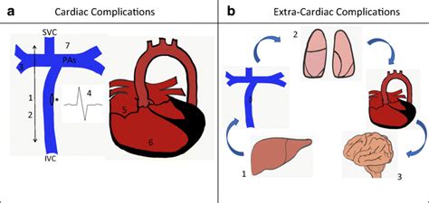 a Fontan palliation connecting the IVC and SVC to the pulmonary... | Download Scientific Diagram